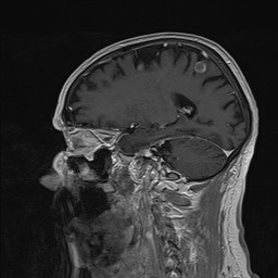 Brain metastasis (Radiopaedia 42617-45761 Sagittal T1 C+ 64).jpg