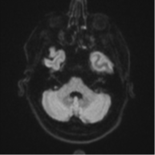 File:Brain metastasis (large cystic mass) (Radiopaedia 47497-52107 Axial DWI 34).png