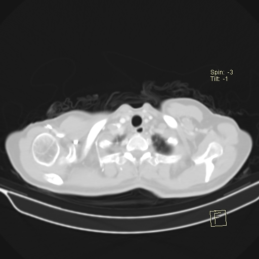 File:Brain metastasis as initial presentation of non-small cell lung cancer (Radiopaedia 65122-74127 Axial lung window 4).jpg