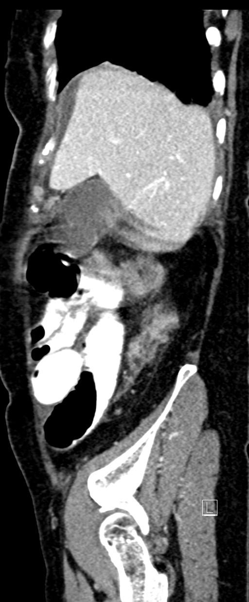 Broad ligament hernia (Radiopaedia 84802-100276 C 69).jpg