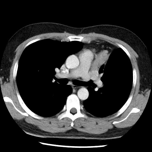 Bronchial carcinoid tumor (Radiopaedia 67377-76764 A 28).jpg