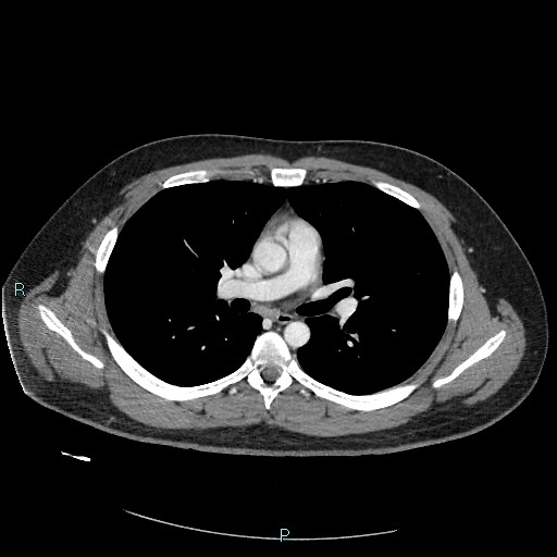 Bronchial carcinoid tumor (Radiopaedia 78272-90875 A 47).jpg