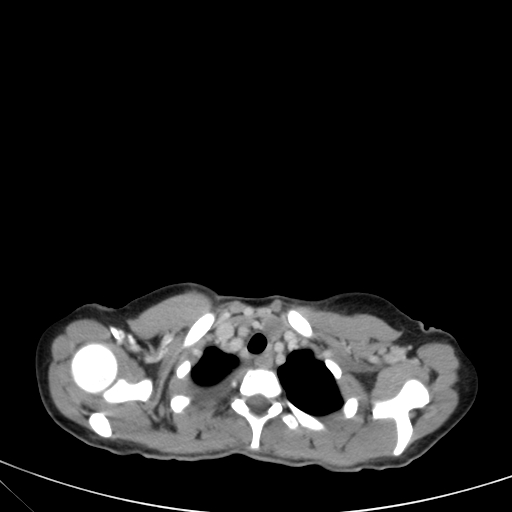 Bronchial mucoepidermoid carcinoma (Radiopaedia 57023-63895 Axial 15).jpg