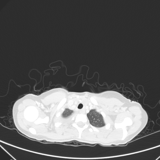 Bronchial mucoepidermoid carcinoma (Radiopaedia 57023-63895 Axial lung window 3).jpg