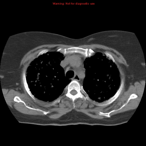 Bronchoalveolar carcinoma (Radiopaedia 13224-13233 Axial non-contrast 13).jpg