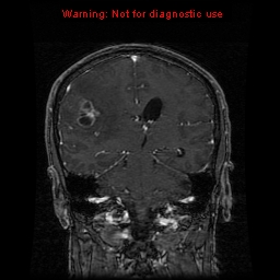 File:Bronchogenic carcinoma brain metastasis (Radiopaedia 9286-9969 Coronal T1 8).jpg