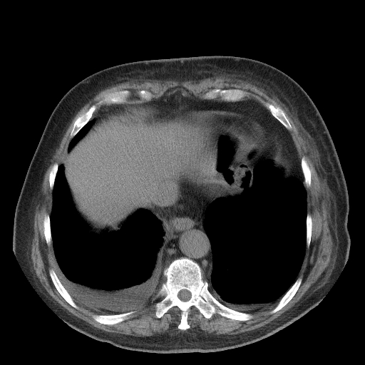 Bronchogenic carcinoma with metastatic lymphadenopathy (Radiopaedia 37671-39569 Axial non-contrast 44).jpg