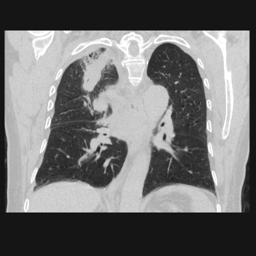 File:Bronchogenic carcinoma with metastatic lymphadenopathy (Radiopaedia 37671-39569 Coronal lung window 30).jpg