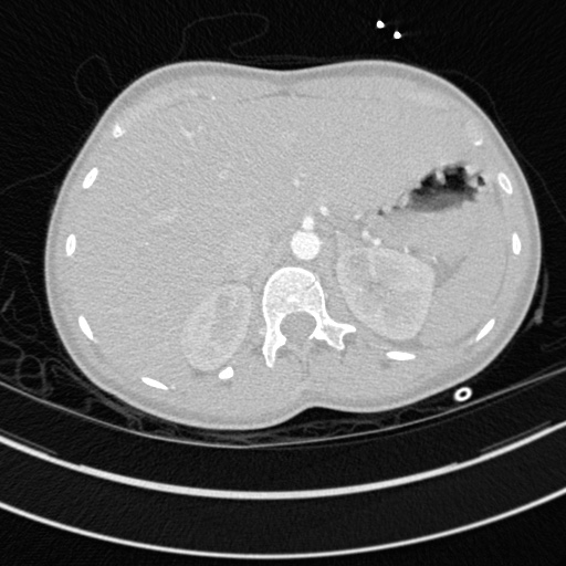 File:Bronchogenic cyst (Radiopaedia 77801-90071 Axial lung window 86).jpg