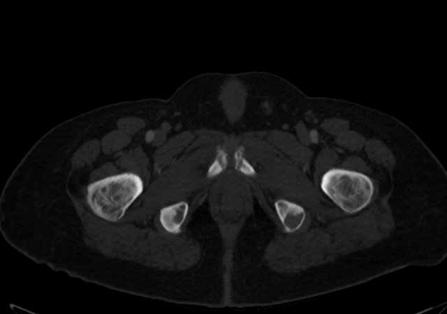 Brown tumors compressing the spinal cord (Radiopaedia 68442-77988 G 134).jpg
