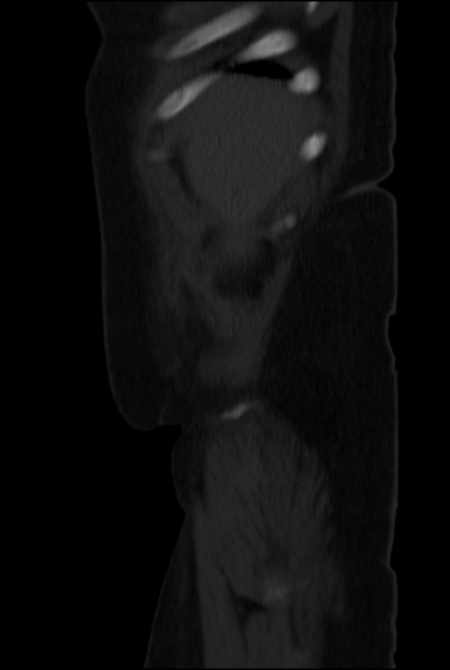 Brown tumors compressing the spinal cord (Radiopaedia 68442-77988 H 6).jpg