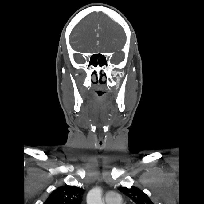 Buccal fat pad arteriovenous malformation (Radiopaedia 70936-81144 B 20).jpg
