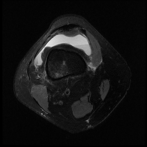 File:Bucket handle meniscus tear (Radiopaedia 56916-63751 Axial PD fat sat 1).jpg