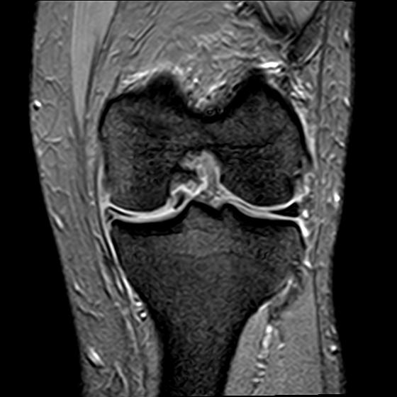 File:Bucket handle tear - medial meniscus (Radiopaedia 29250-29664 B 12).jpg