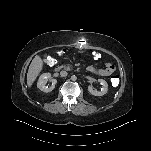 File:Buried bumper syndrome - gastrostomy tube (Radiopaedia 63843-72575 Axial Inject 11).jpg