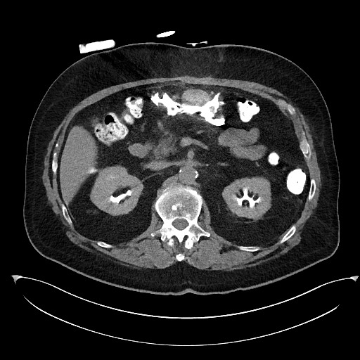 Buried bumper syndrome - gastrostomy tube (Radiopaedia 63843-72577 Axial Inject 36).jpg