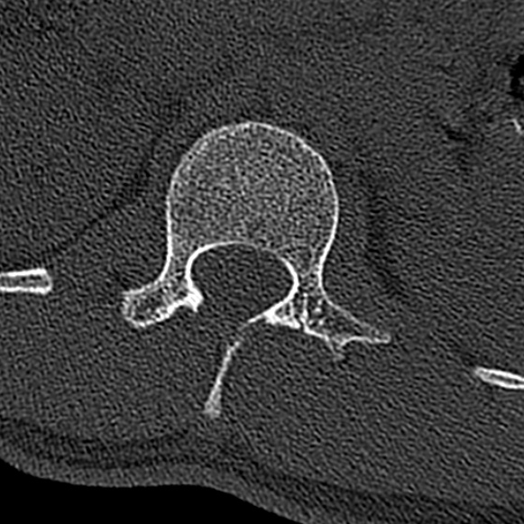 Burst fracture (Radiopaedia 53373-59357 Axial bone window 10).jpg