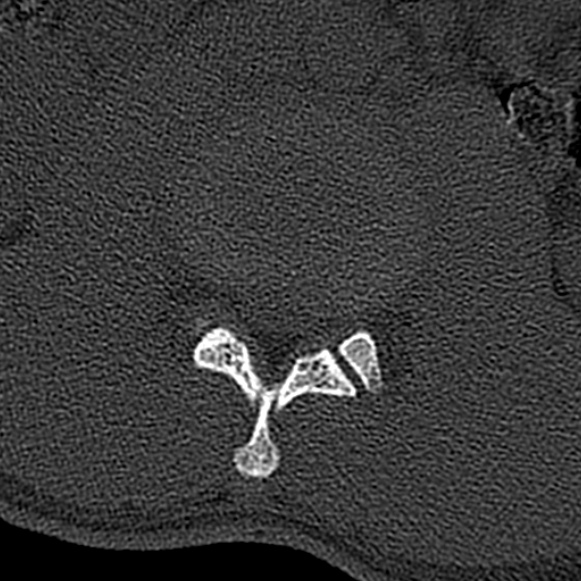 Burst fracture (Radiopaedia 53373-59357 Axial bone window 28).jpg