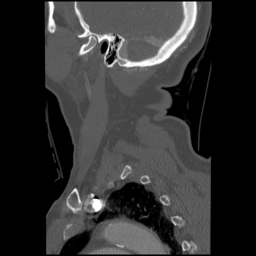 File:C1 anterior arch (plough) fracture - type 1 (Radiopaedia 76181-87720 Sagittal bone window 20).jpg