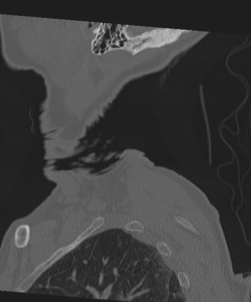 C2 fracture with vertebral artery dissection (Radiopaedia 37378-39199 Sagittal bone window 6).png