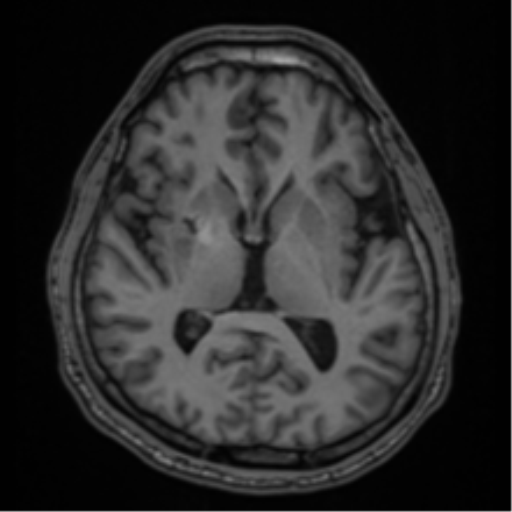 CNS vasculitis (Radiopaedia 55715-62263 Axial T1 31).png