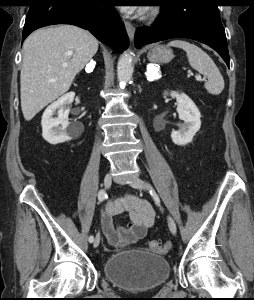 Calcified adrenal glands and Spigelian hernia (Radiopaedia 49741-54988 B 64).jpg