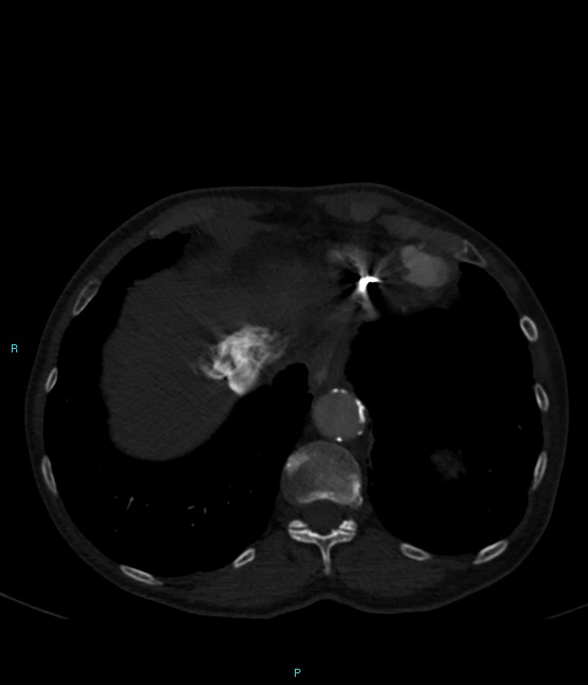 Calcified cerebral emboli from left ventricular thrombus (Radiopaedia 84420-99760 Axial bone window 71).jpg