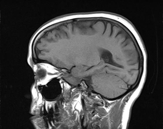 File:Calcified cerebral hydatid cyst (Radiopaedia 65603-74699 Sagittal T1 14).jpg