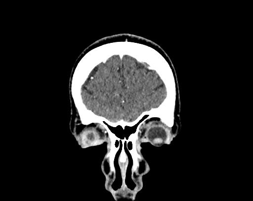 File:Calcified cerebral hydatid cyst (Radiopaedia 65603-74717 C 4).jpg