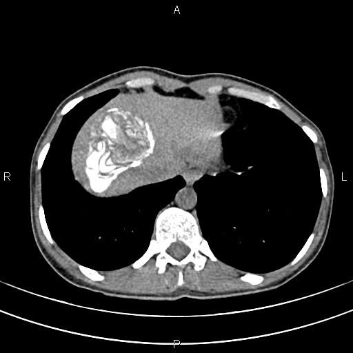File:Calcified hepatic hydatid cyst (Radiopaedia 83870-99072 Axial non-contrast 18).jpg