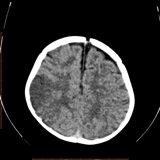 File:Calcified middle cerebral artery embolism (Radiopaedia 78949-91860 Axial non-contrast 20).jpg