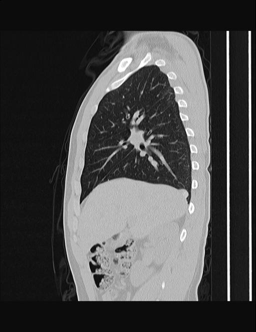Calcifying pulmonary metastases (Radiopaedia 33359-34396 Sagittal lung window 48).jpg