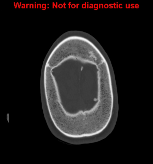 Calvarial thickening from chronic shunting (Radiopaedia 60079-67637 Axial bone window 167).jpg