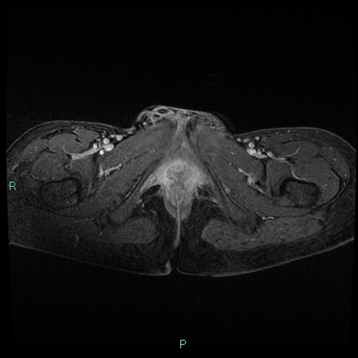 File:Canal of Nuck cyst (Radiopaedia 55074-61448 Axial T1 C+ fat sat 55).jpg