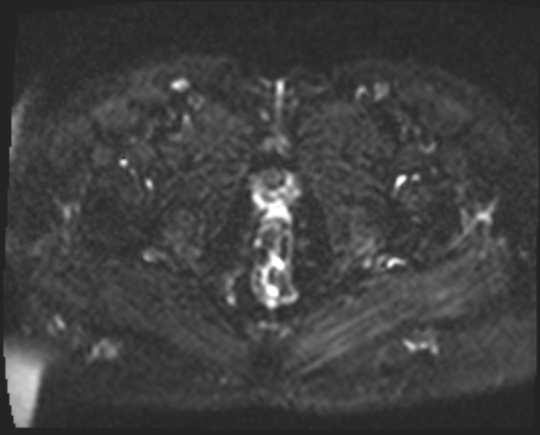 Cancer cervix - stage IIb (Radiopaedia 75411-86615 Axial DWI 4).jpg