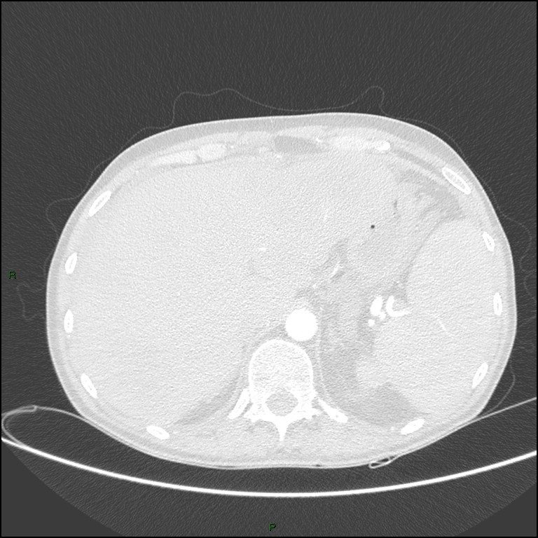 Cannonball metastases (Radiopaedia 82110-96150 Axial lung window 188).jpg
