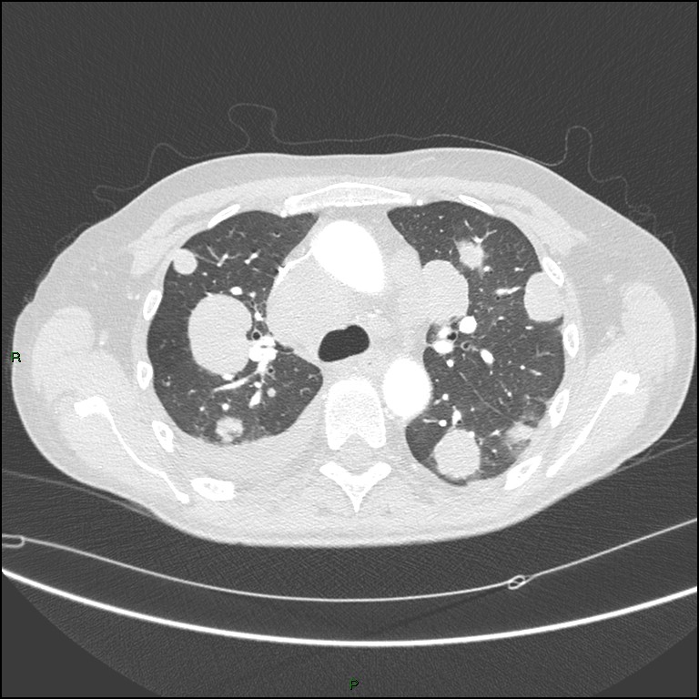 Cannonball metastases (Radiopaedia 82110-96150 Axial lung window 73).jpg