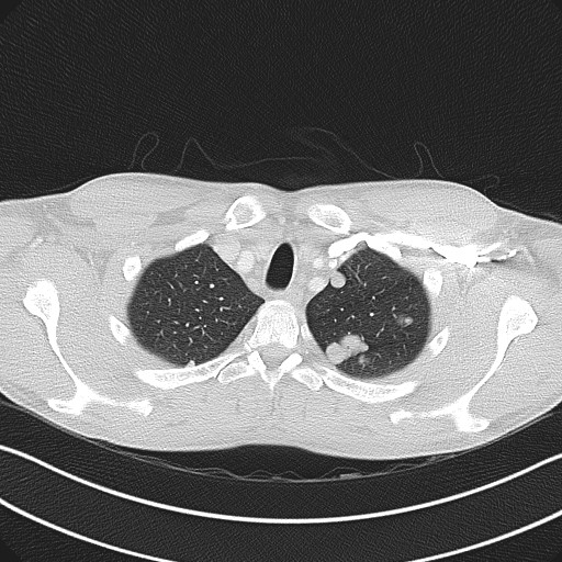 File:Cannonball metastases - testicular choriocarcinoma (Radiopaedia 84510-99891 Axial lung window 18).jpg