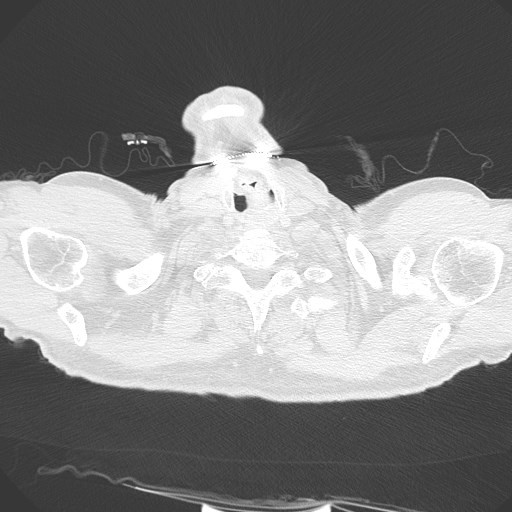 Caplan syndrome (Radiopaedia 56667-63530 Axial lung window 5).jpg
