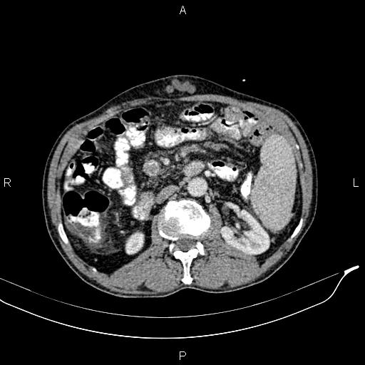 Caput medusae sign - portal hypertension (Radiopaedia 64007-72759 A 40).jpg