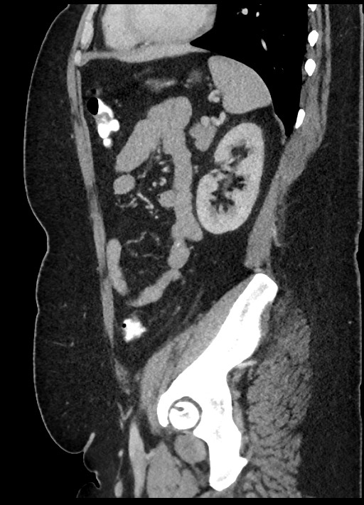 Carcinoid tumor - terminal ileum (Radiopaedia 60931-68739 C 25).jpg