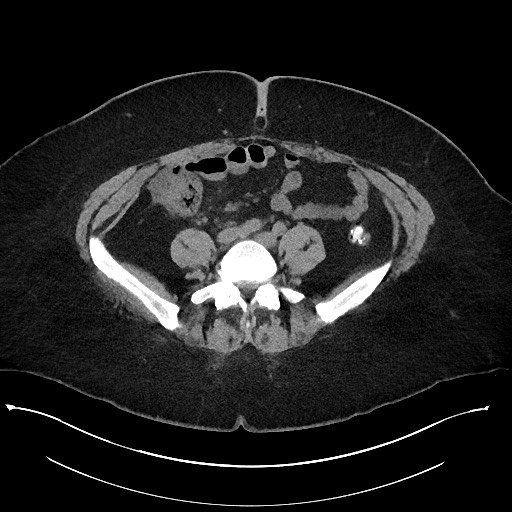 Carcinoid tumor - terminal ileum (Radiopaedia 60931-68740 Axial non-contrast 77).jpg
