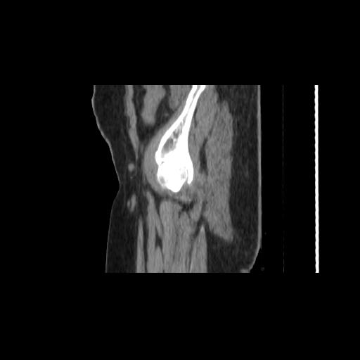 Carcinoma cervix- brachytherapy applicator (Radiopaedia 33135-34173 D 2).jpg