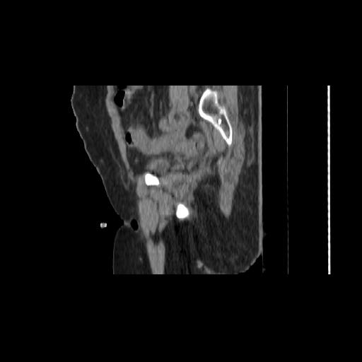 File:Carcinoma cervix- brachytherapy applicator (Radiopaedia 33135-34173 D 51).jpg