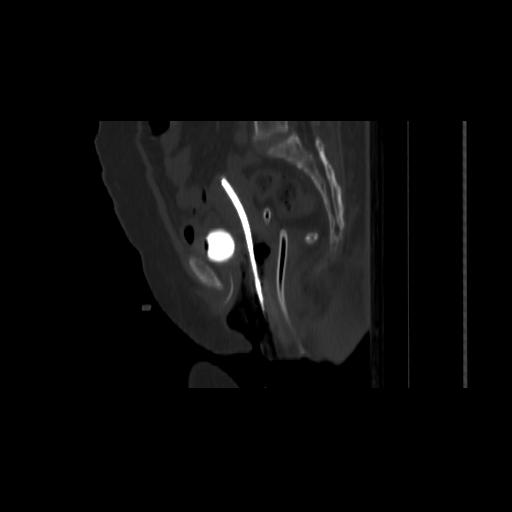 File:Carcinoma cervix- brachytherapy applicator (Radiopaedia 33135-34173 Sagittal bone window 86).jpg