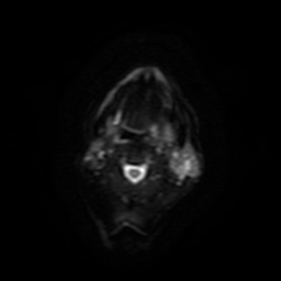 File:Carcinoma ex-pleomorphic adenoma of parotid (Radiopaedia 28383-28627 Ax DWI B-500 GE 12).jpg