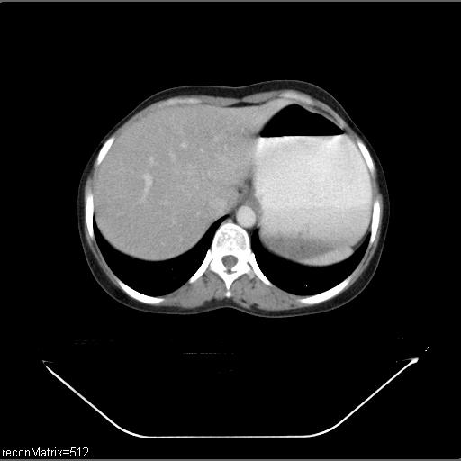 File:Carcinoma of esophagus (Radiopaedia 27356-27550 A 6).jpg