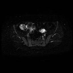 Carcinoma of the cervix (Radiopaedia 89018-105858 Axial DWI 20).jpg