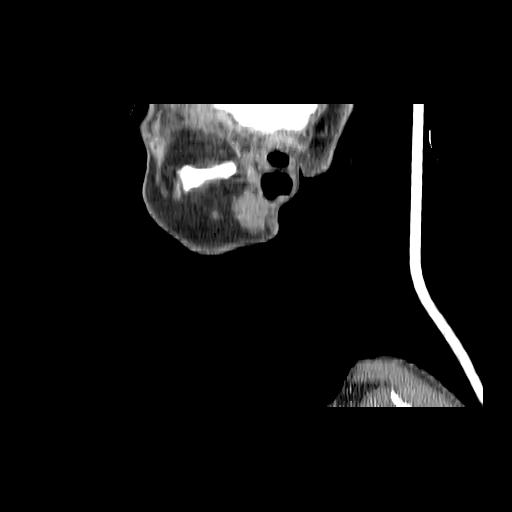 Carcinoma of the maxillary antrum (Radiopaedia 53805-59888 Sagittal C+ delayed 168).jpg