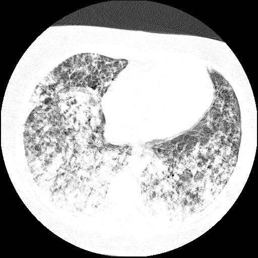 Cardiac angiosarcoma (Radiopaedia 66010-75181 Axial lung window 28).jpg